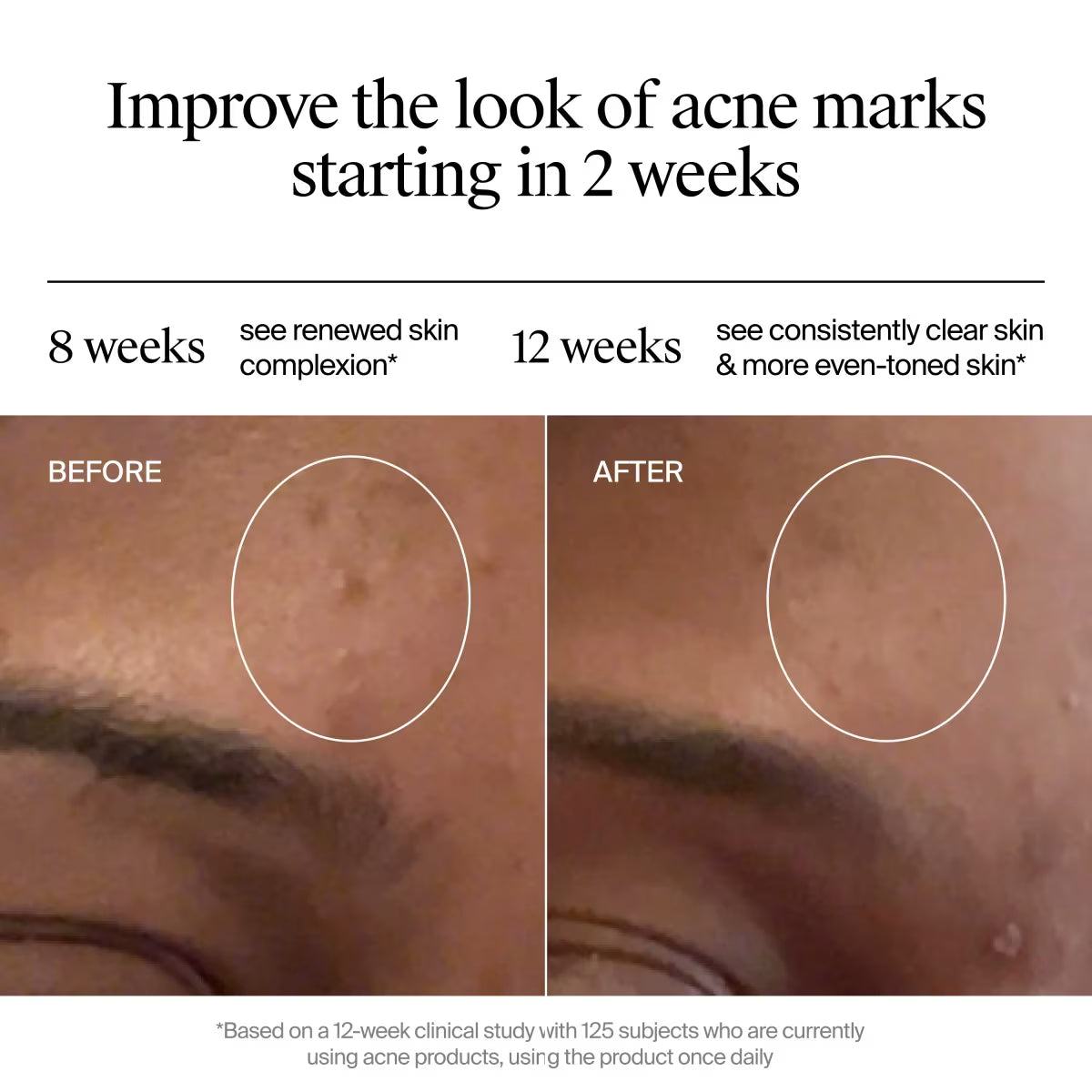 Neutrogena® Evenly Clear™ Retinoid Adapalene Gel 0.1% Acne Treatment, 0.5 Oz - US 0396