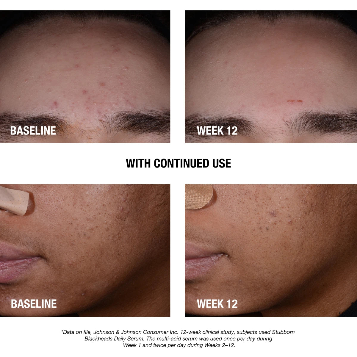 Neutrogena® Stubborn Blackheads Daily Acne Facial Serum, 1 Fl. Oz - US 7090