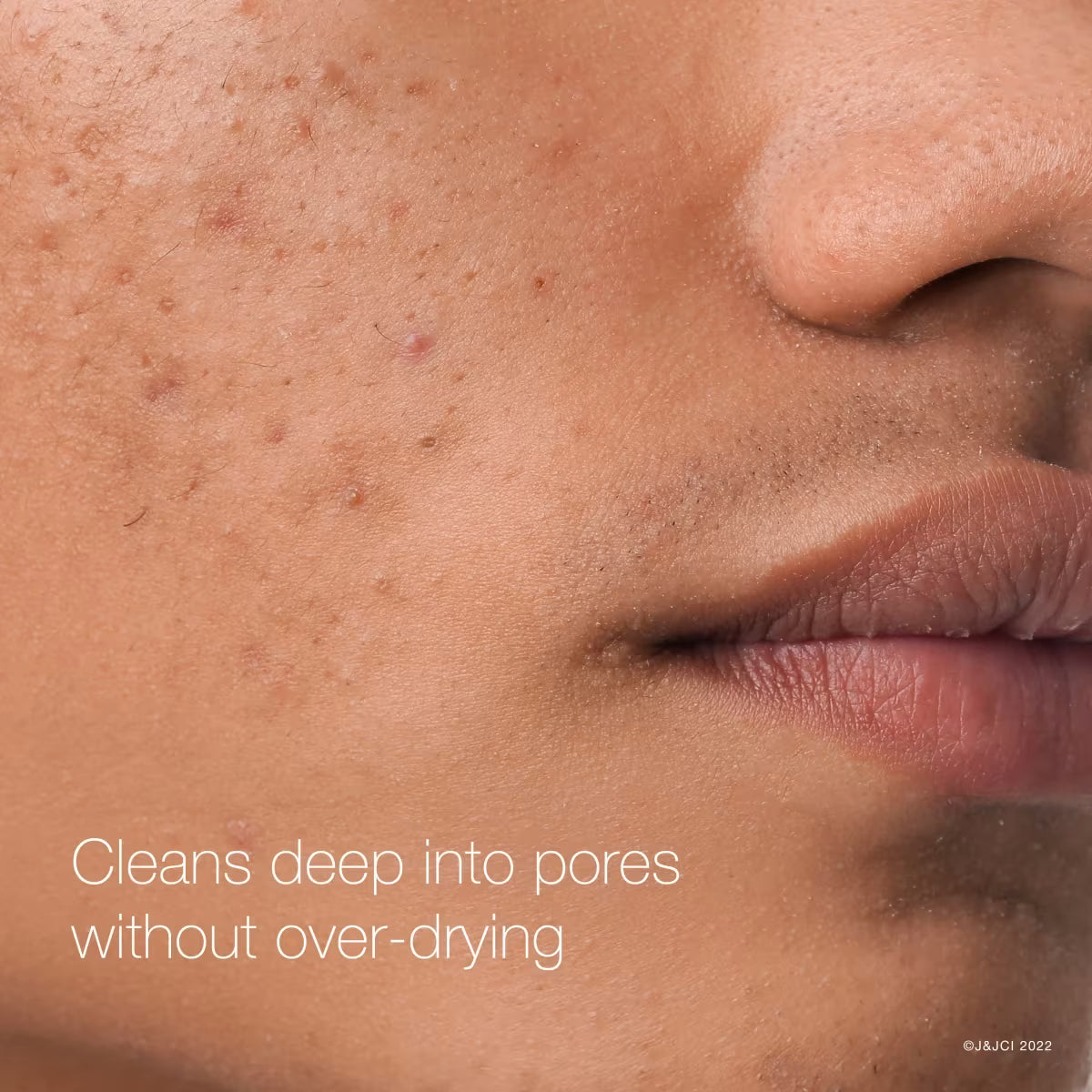 Neutrogena® Rapid Clear Maximum Strength Treatment Pads, 60 Count - US 6863